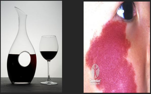 Wine decanter and glass with red wine on the left; close-up of a skin condition on the right.
