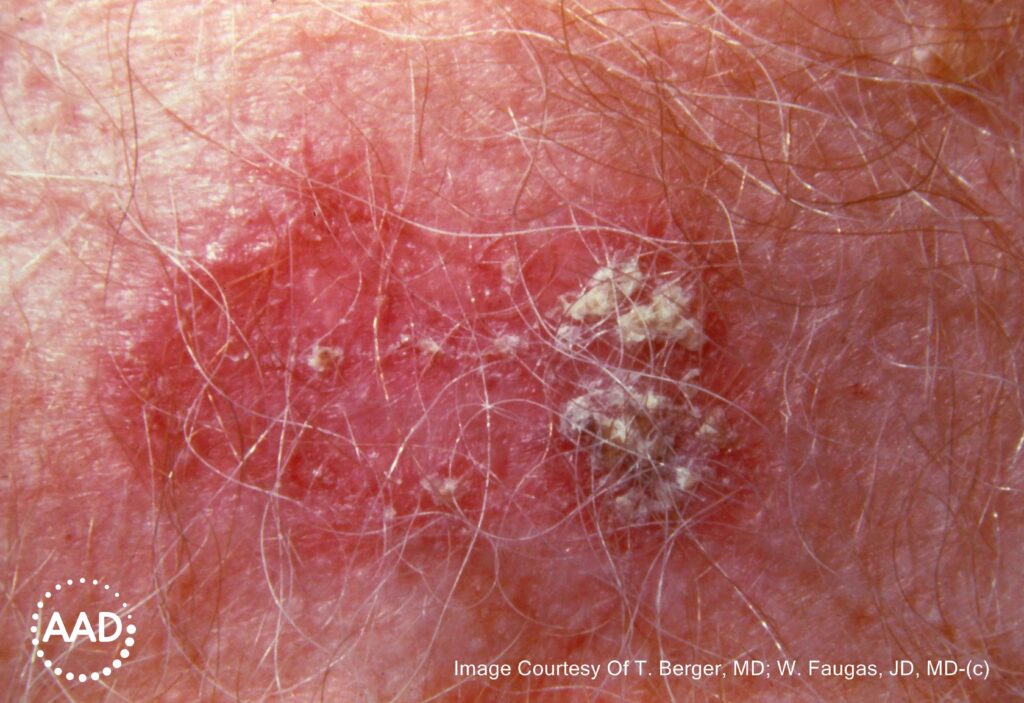 squamous cell carcinoma