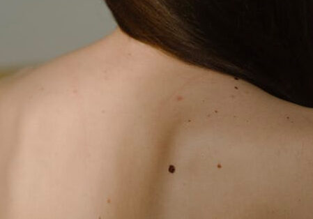 mole Mole Removal