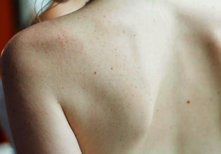 skincancer skin cancer screening